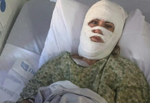 Georgia woman suffers severe burns in chemical attack at a Savannah park